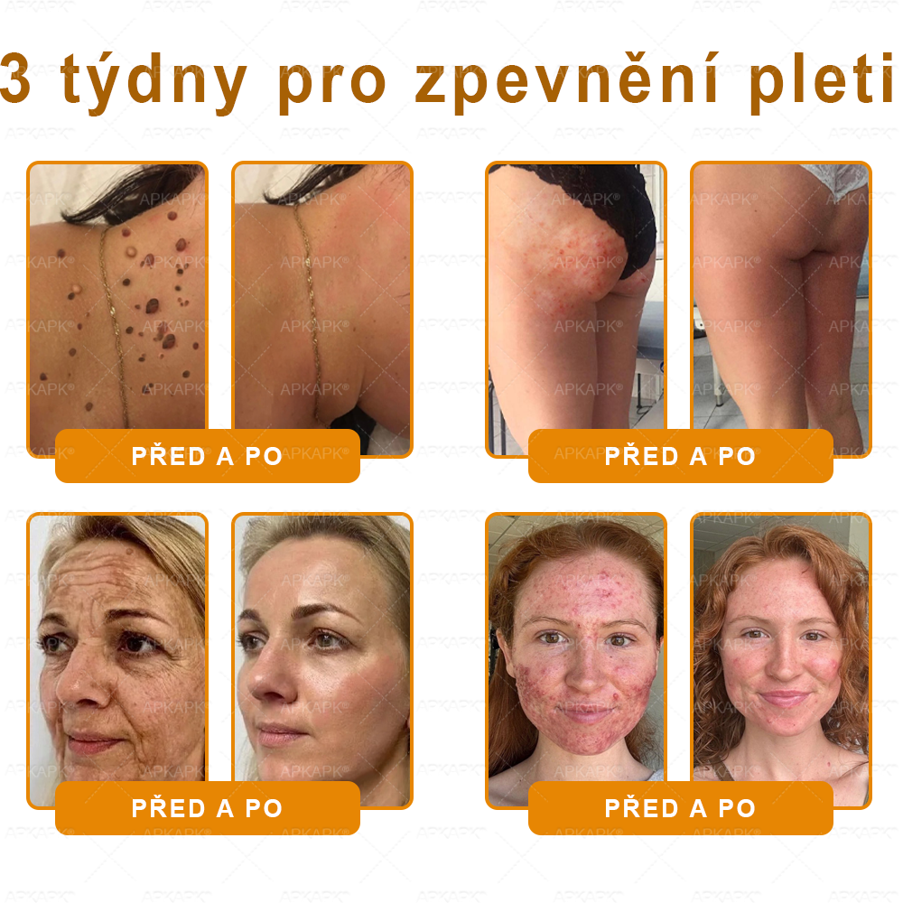 👑Zbývá pouze 5 krabic! ⭐Dodatečná sleva 50%! Pokud nyní zmeškáte, získáte ji až příští rok – 𝖠𝖯𝖪𝖠𝖯𝖪® medově jedový krém na obnovu pokožky
