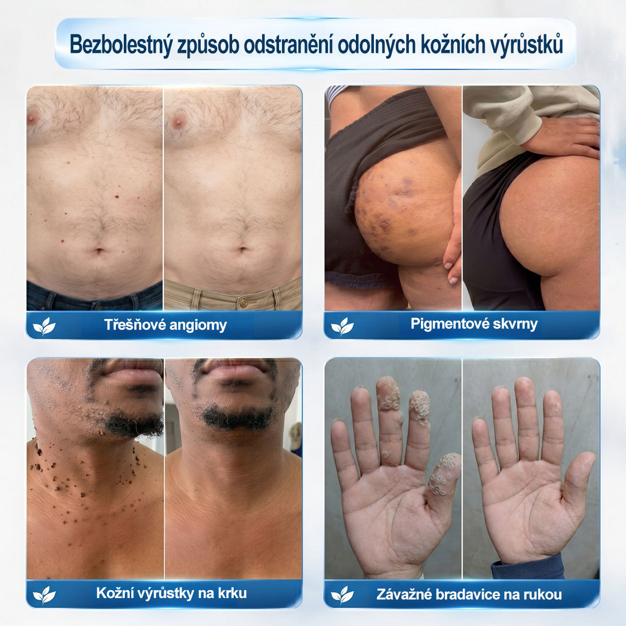 💛✅Oficiální značkový obchod | Hiskin® 7denní odstraňovač skvrn a pigmentových skvrn (Bezbolestný rollerball bez jizev)🐬（副本）