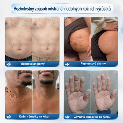 💛✅Oficiální značkový obchod | Hiskin® 7denní odstraňovač skvrn a pigmentových skvrn (Bezbolestný rollerball bez jizev)🐬（副本）