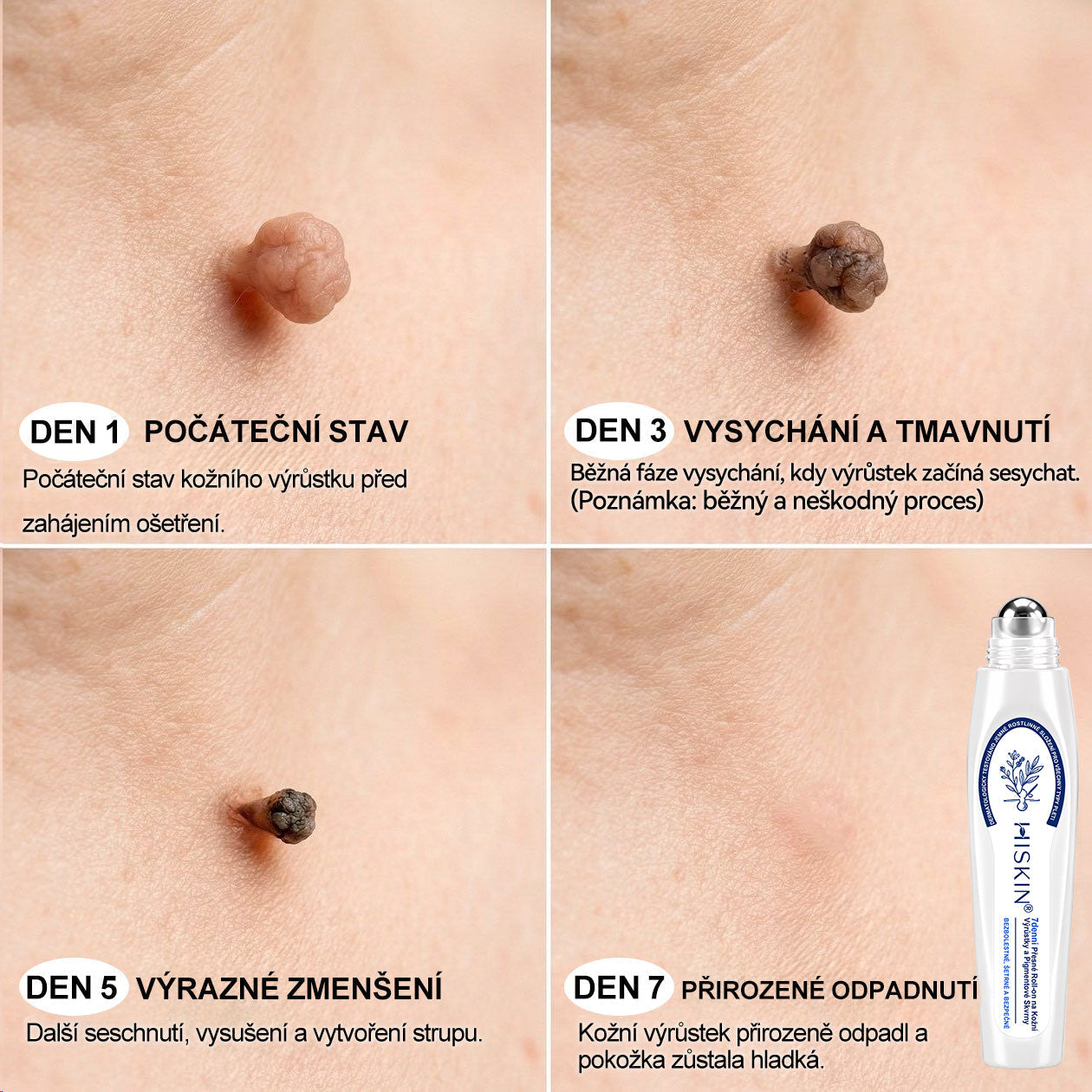 💛✅Oficiální značkový obchod | Hiskin® 7denní odstraňovač skvrn a pigmentových skvrn (Bezbolestný rollerball bez jizev)🐬（副本）